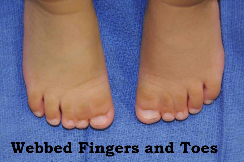 Webbed Fingers and Toes
